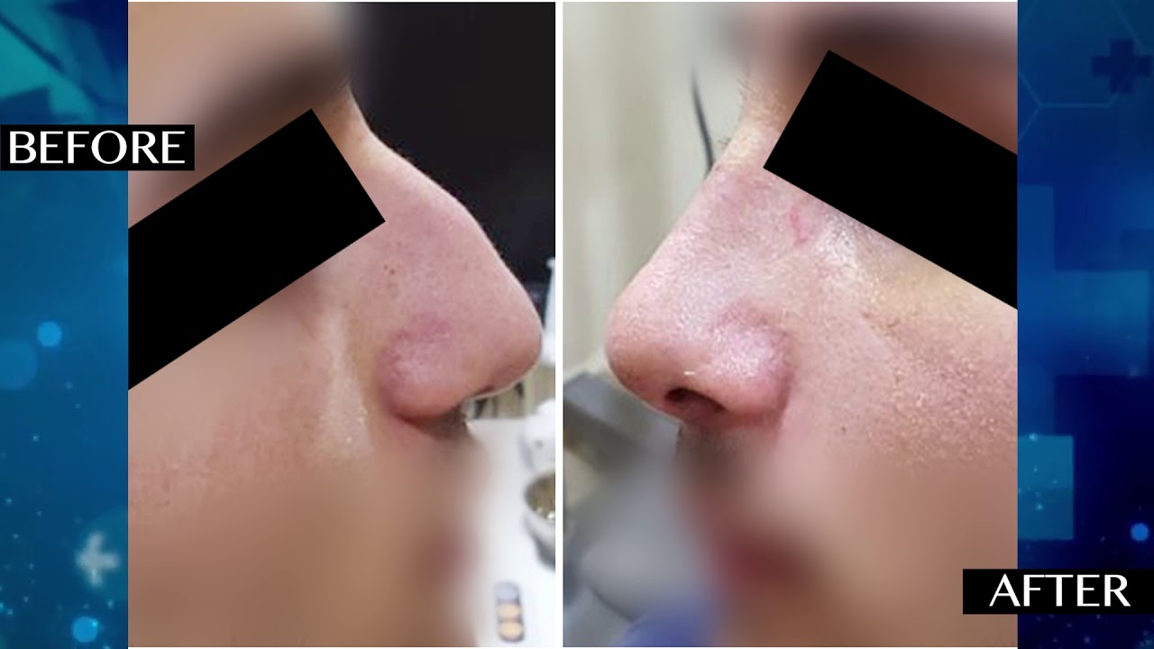 Dr Basil ,  Rhinoplasty ,  الدكتور باسل الدبس أخصائي أنف - اذن و حنجرة في مستشفى اوريانا بالشارقة