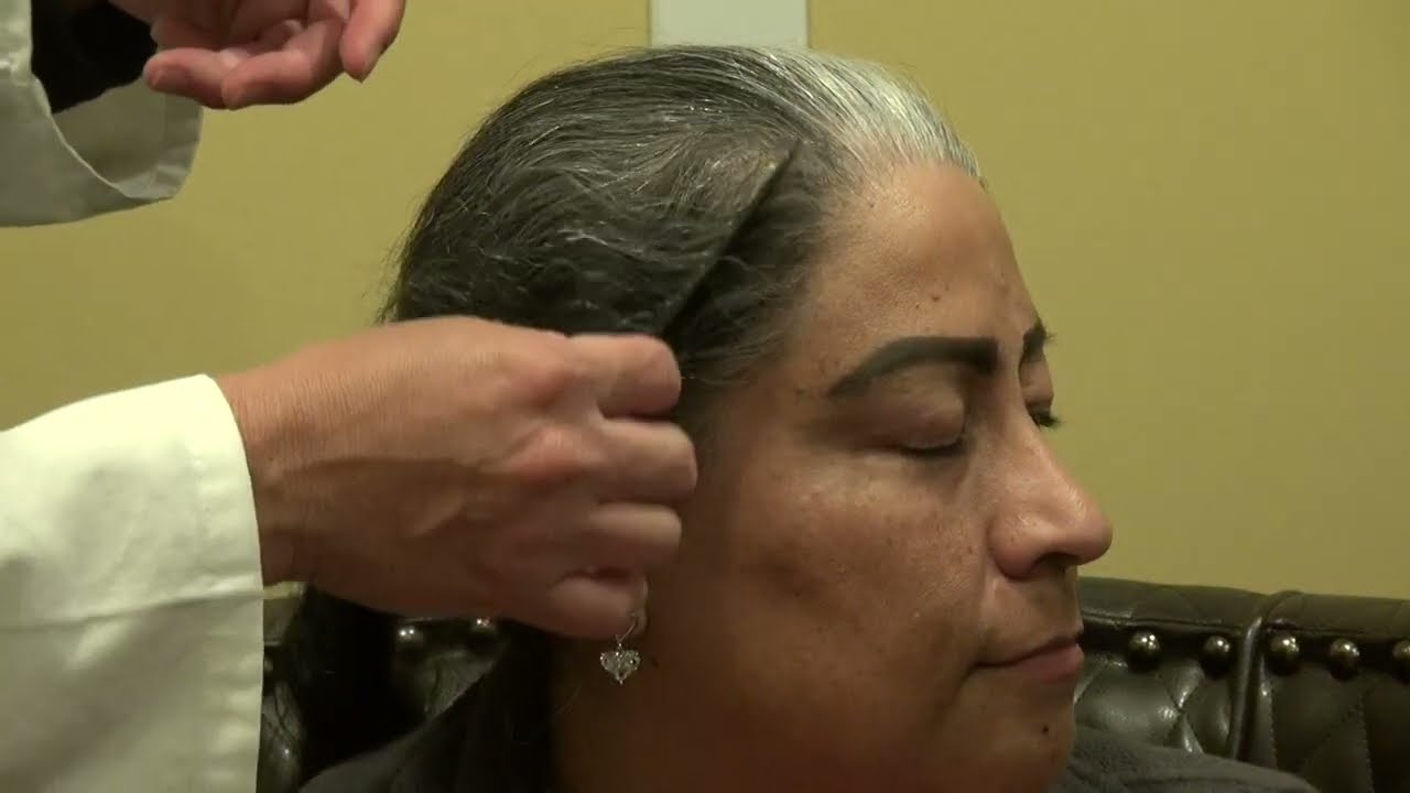 1 Year After Hair Transplant Surgery: Amazing Results & Natural Growth!