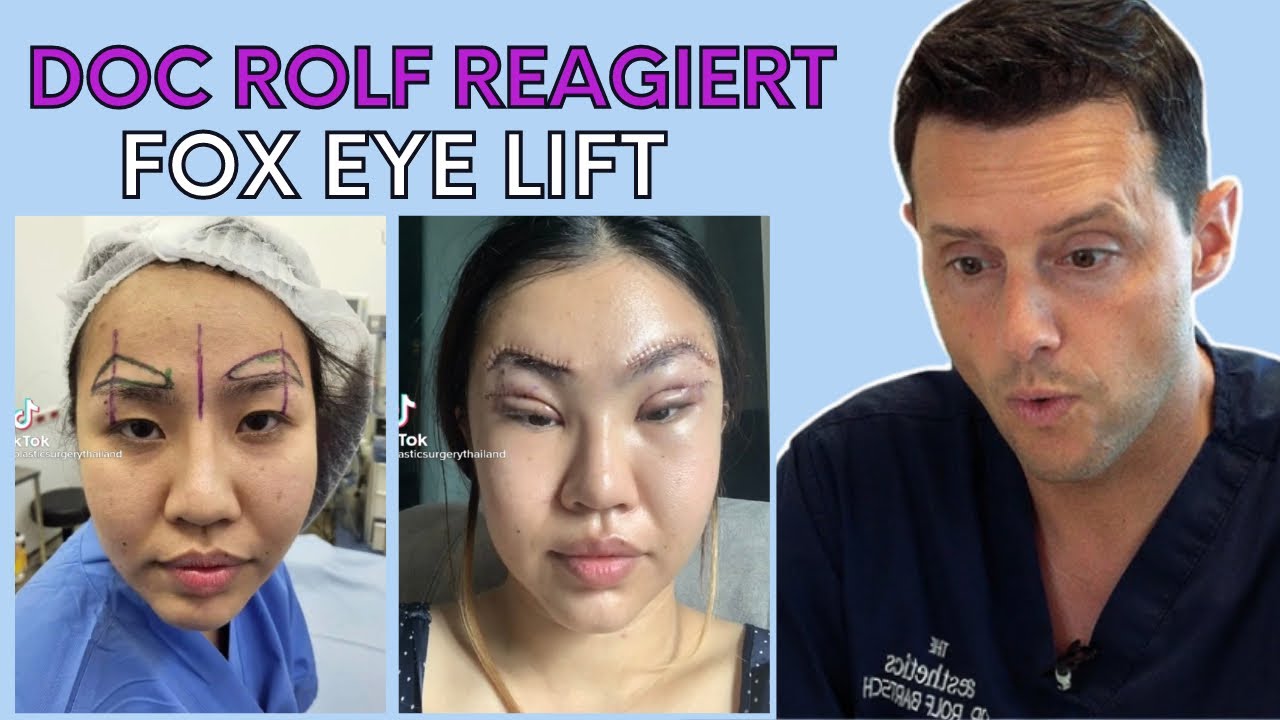 AUGENBRAUENLIFTING & OBERLIDSTRAFFUNG &ndash; Fox Eye Lift &ndash; Patientin kann Auge kaum schlie&szlig;en?!?