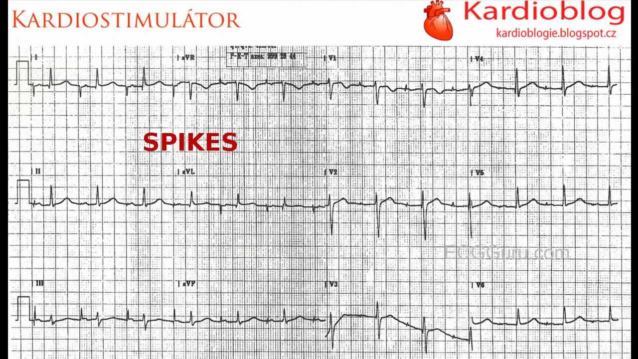 Kardioblog - Síňový pacemaker
