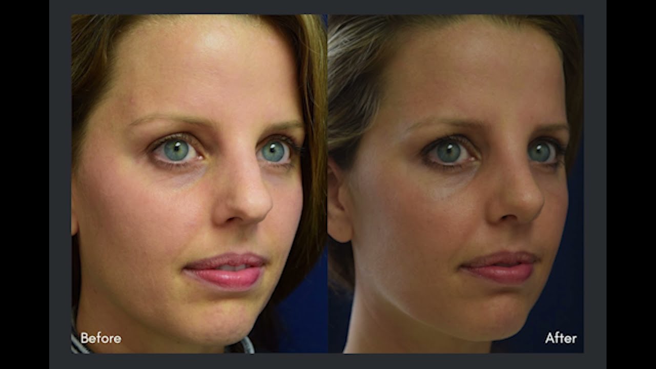 Surgical Rhinoplasty vs. Liquid Rhinoplasty Explained by Dr. Jack Scheuer