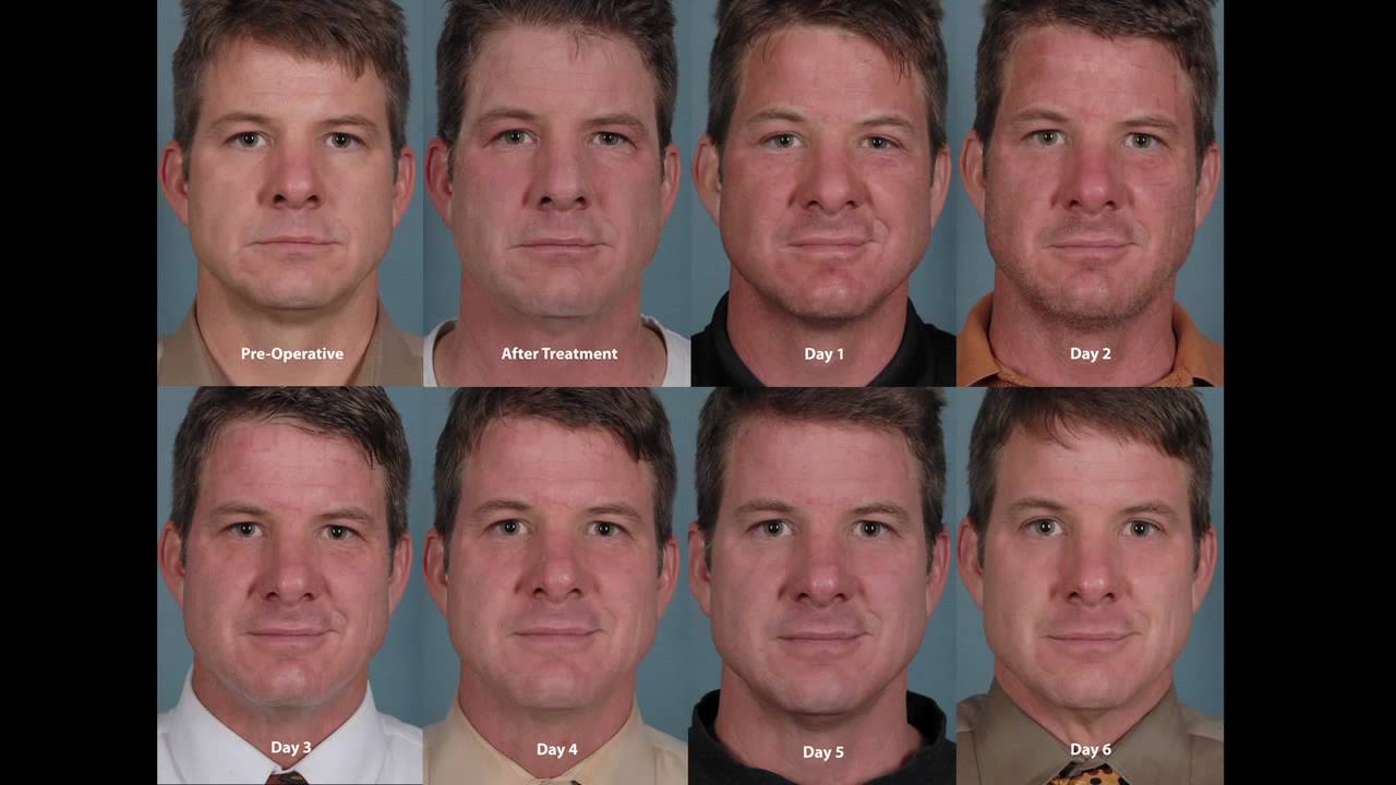 Denver Plastic Surgeon's CO2 Laser Resurfacing Skin Care Treatment and Recovery