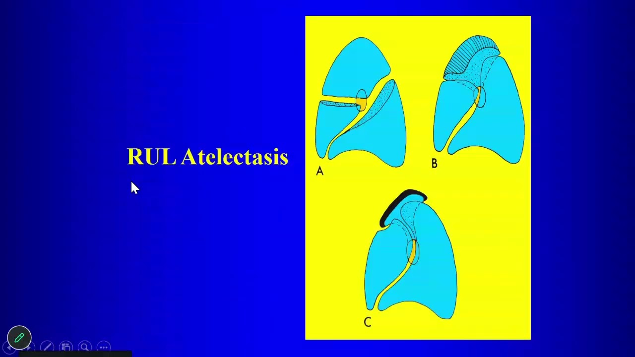 17 Pneumomediastinum, Atelectasis, Emphysema, Hyperlucent Hemithorax