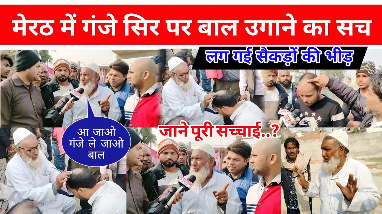 गंजे सिर पर बाल उगाने का सच! Meerut में लग गई सैकड़ों की भीड़, जानें पूरी सच्चाई | hair growth