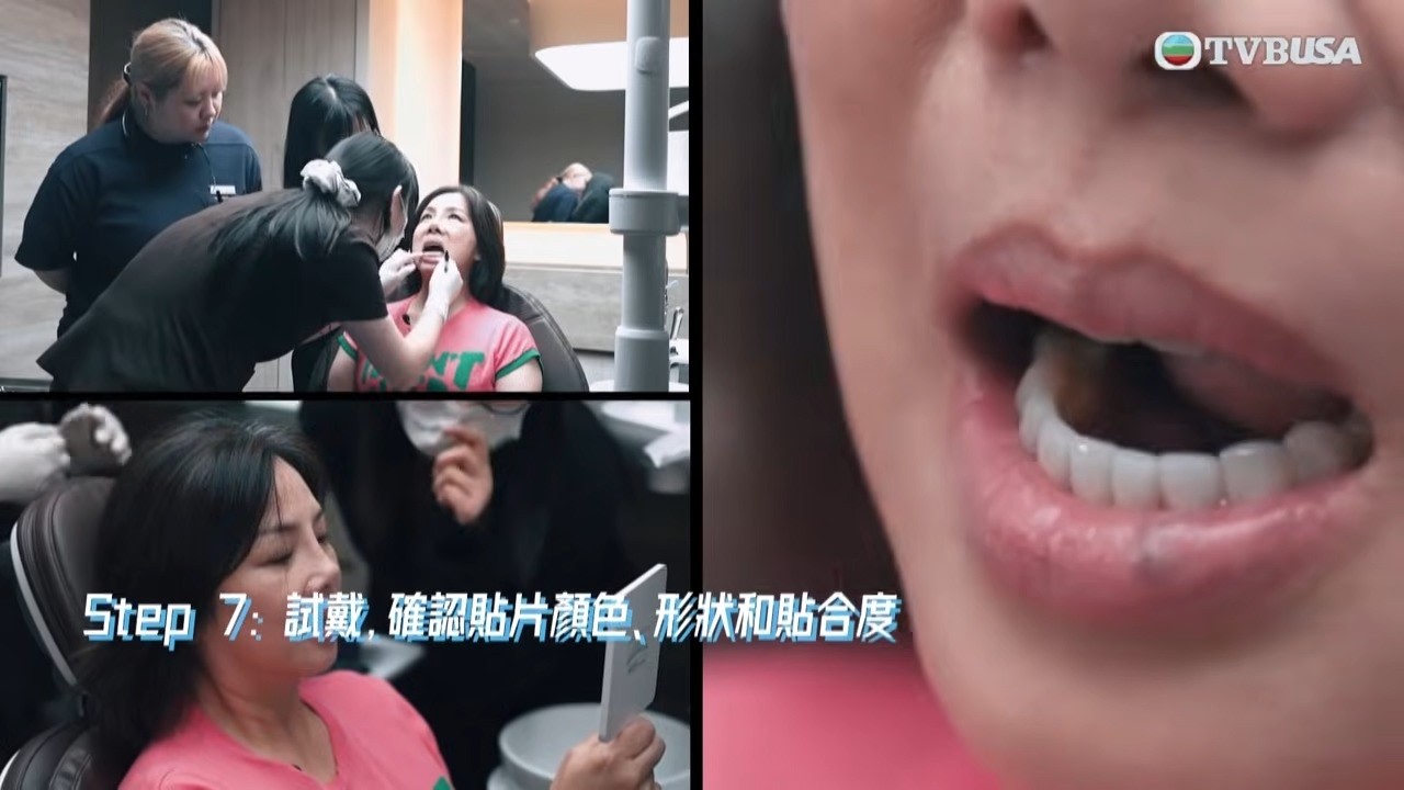 醫美直擊 首爾篇｜年少戴金屬牙套留後遺？ 梓瑋花逾十萬港幣做牙貼片　即日完成療程換半永久笑容｜何依婷｜韓國｜醫美