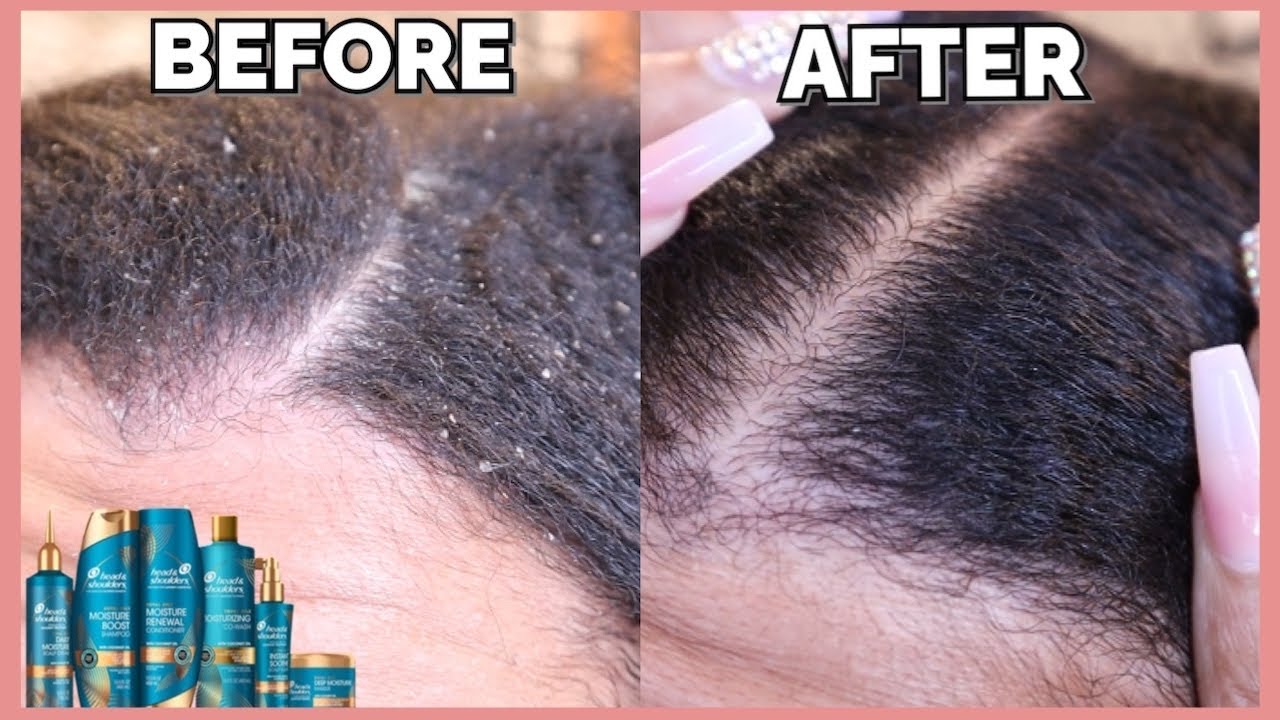 Instant Relief For Dandruff & Itchy Scalp!: Head And Shoulders Royal Oils Review| LEILANI IMAN