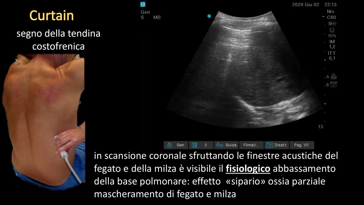 eco torace versamento pleurico
