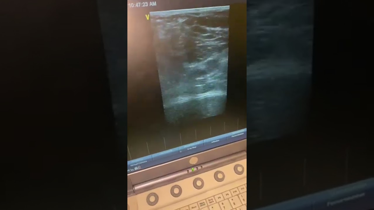 Identifying the veins in the Lower Extremity