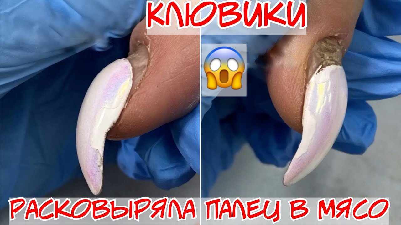 Как исправить клюющие ногти 🐔 Расковыряла ногти в мясо 😱 Ногти от другого мастера. nail vlog