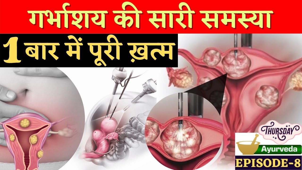 गर्भाशय की गाँठ (FIBROID) 1 बार में पूरी ख़त्म - Kaise ?? Ayurvedic Treatment of Fibroids in Hindi