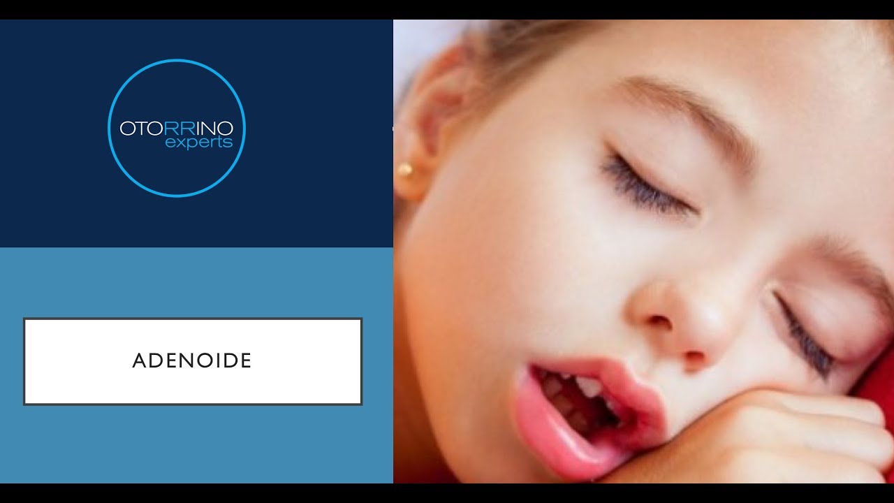 Adenoide (carne esponjosa) - precisa operar?
