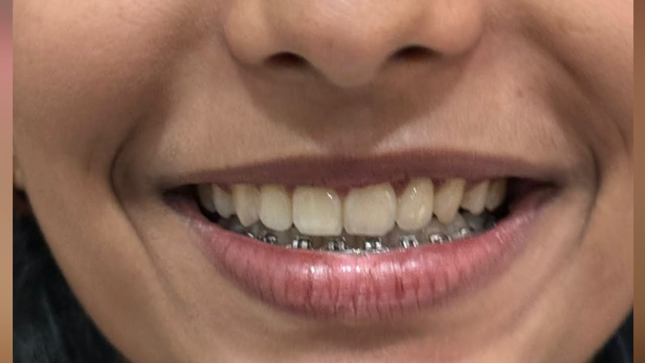 Braces Removed? Now What? Retainers Explained..