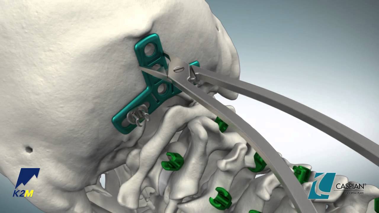 CASPIAN® Occipital Plate Product Animation