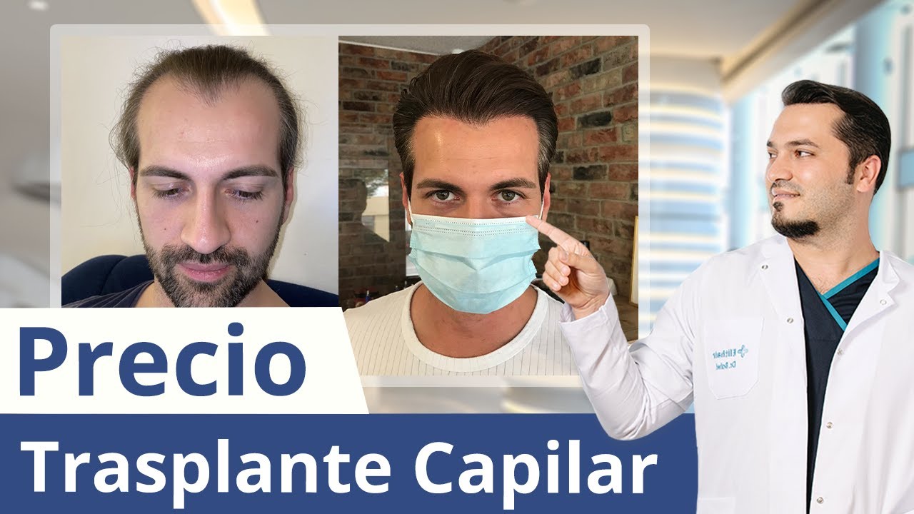 ¿Cuánto cuesta un trasplante capilar? El Dr. Balwi lo explica