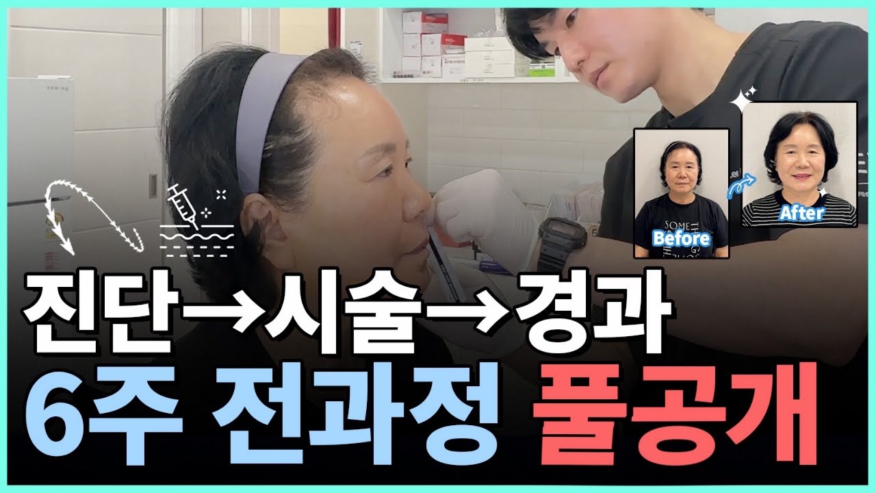60대 첫 실리프팅, 이렇게 달라집니다｜실리프팅&middot;필러&middot;보톡스 &lsquo;전 과정&rsquo; 실제 공개