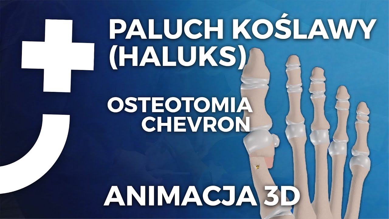 Operacja palucha koślawego - Osteotomia chevron - animacja 3D