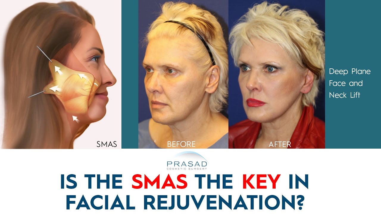 The SMAS and Its Role in Facial Rejuvenation