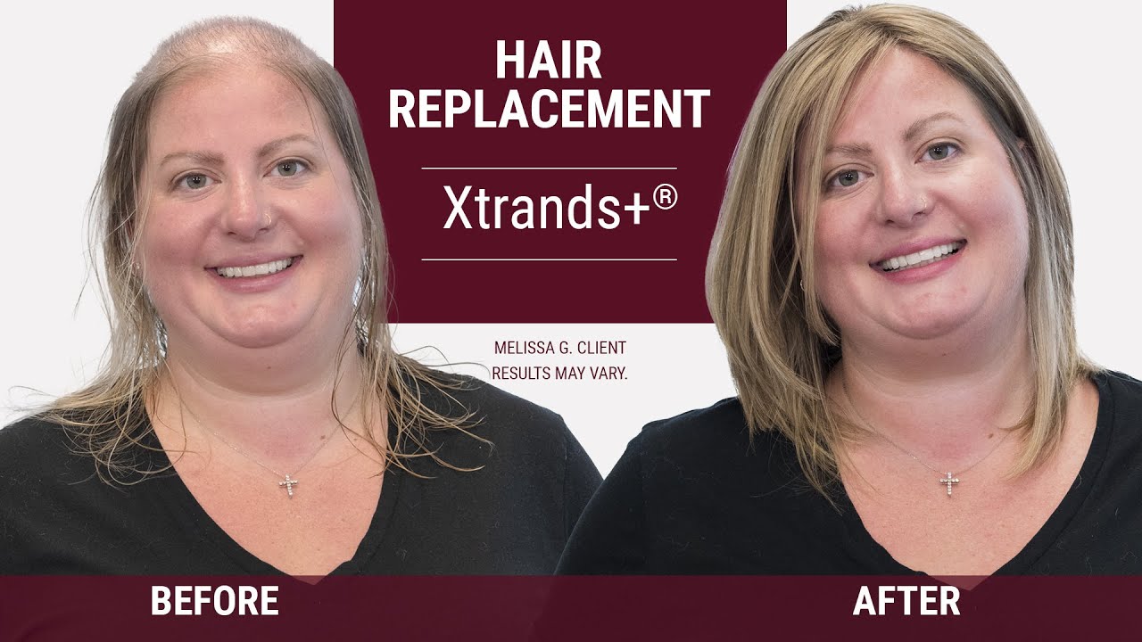 Finally there is an answer for female hair loss [ Xtrands+ Hair Replacement ]