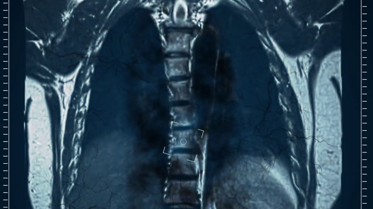 Concerns over Tuberculosis