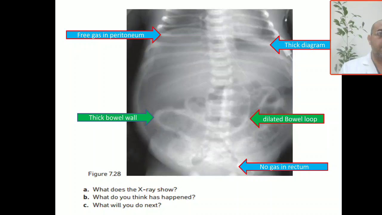 Case 108 intestinal perforation, intestinal obstruction, colonic atresia,  bilious vomiting,