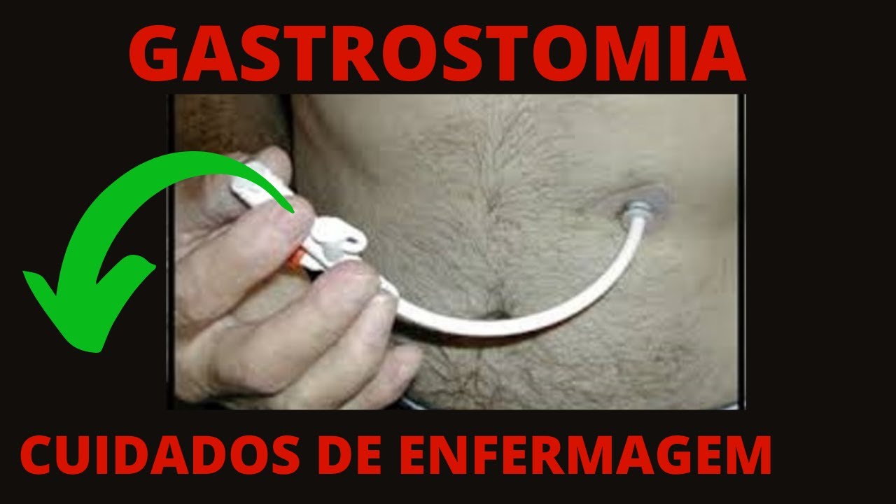 Gastrostomia e a Enfermagem  - Cuidados de enfermagem com gastrostomia