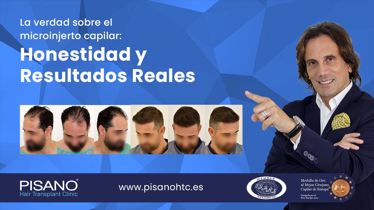 La verdad sobre el microinjerto capilar: Honestidad y Resultados Reales