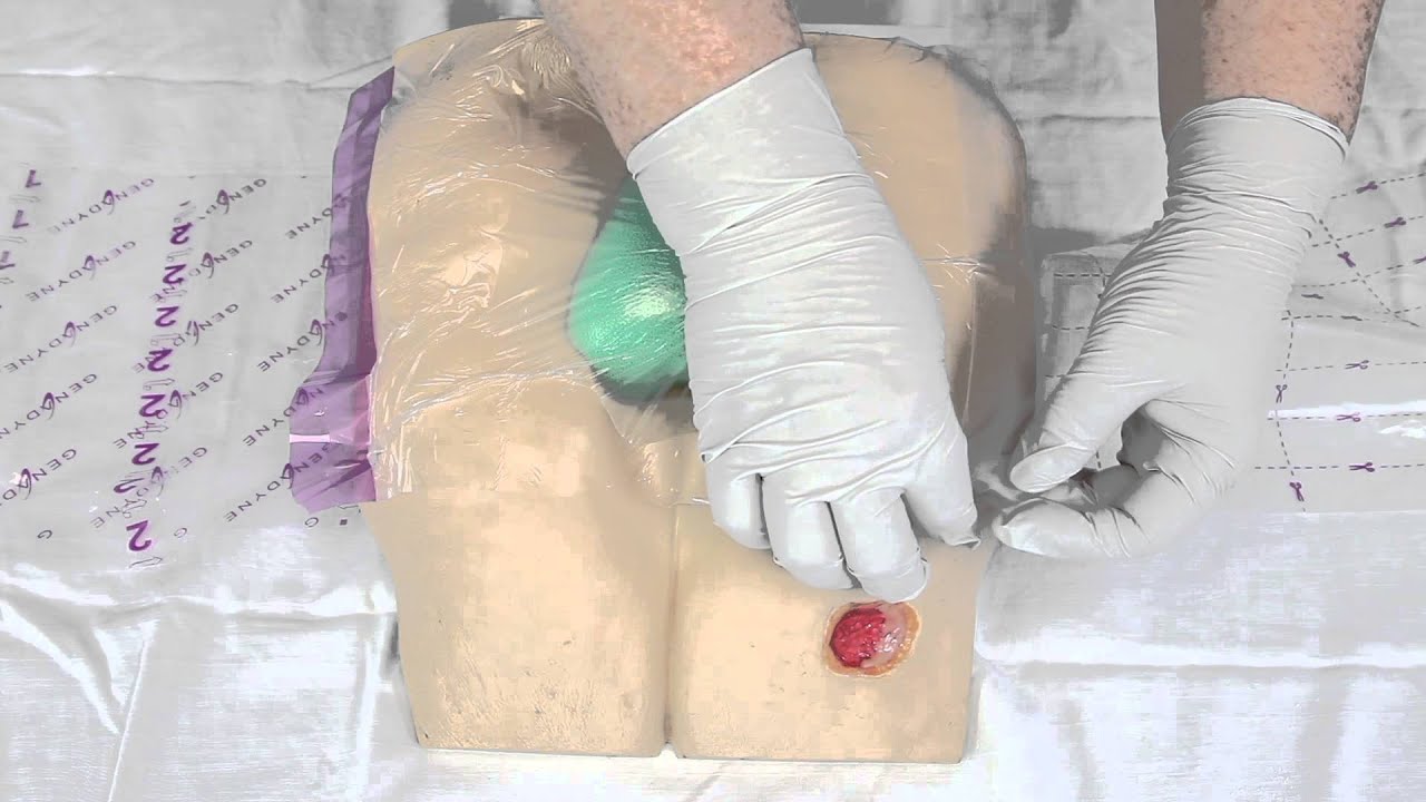 Basic Dressing Technique for Negative Pressure Wound Therapy