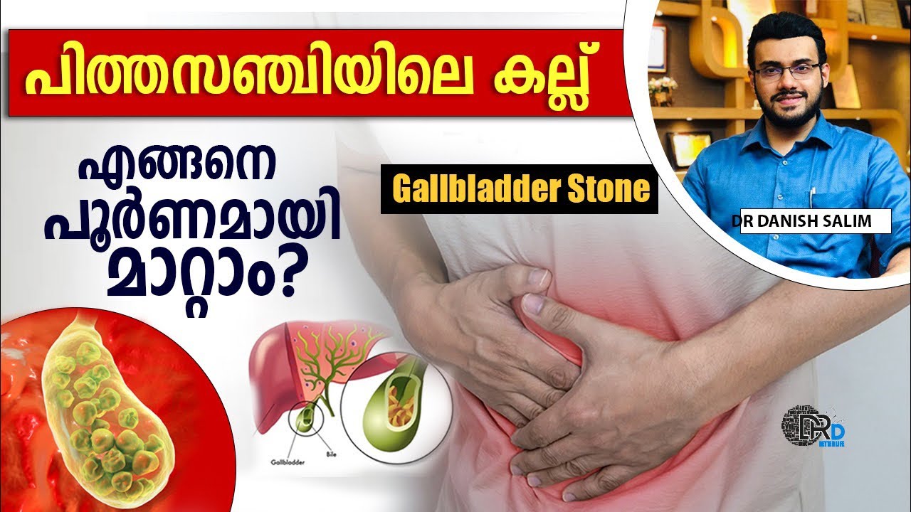 1369: പിത്തസഞ്ചിയിൽ കല്ലുള്ളവർക്ക് എന്ത് ചികിത്സയാണ് എടുക്കേണ്ടത് ? Treatment of Gall bladder stone