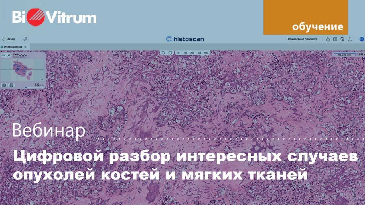 Цифровой разбор интересных случаев опухолей костей и мягких тканей