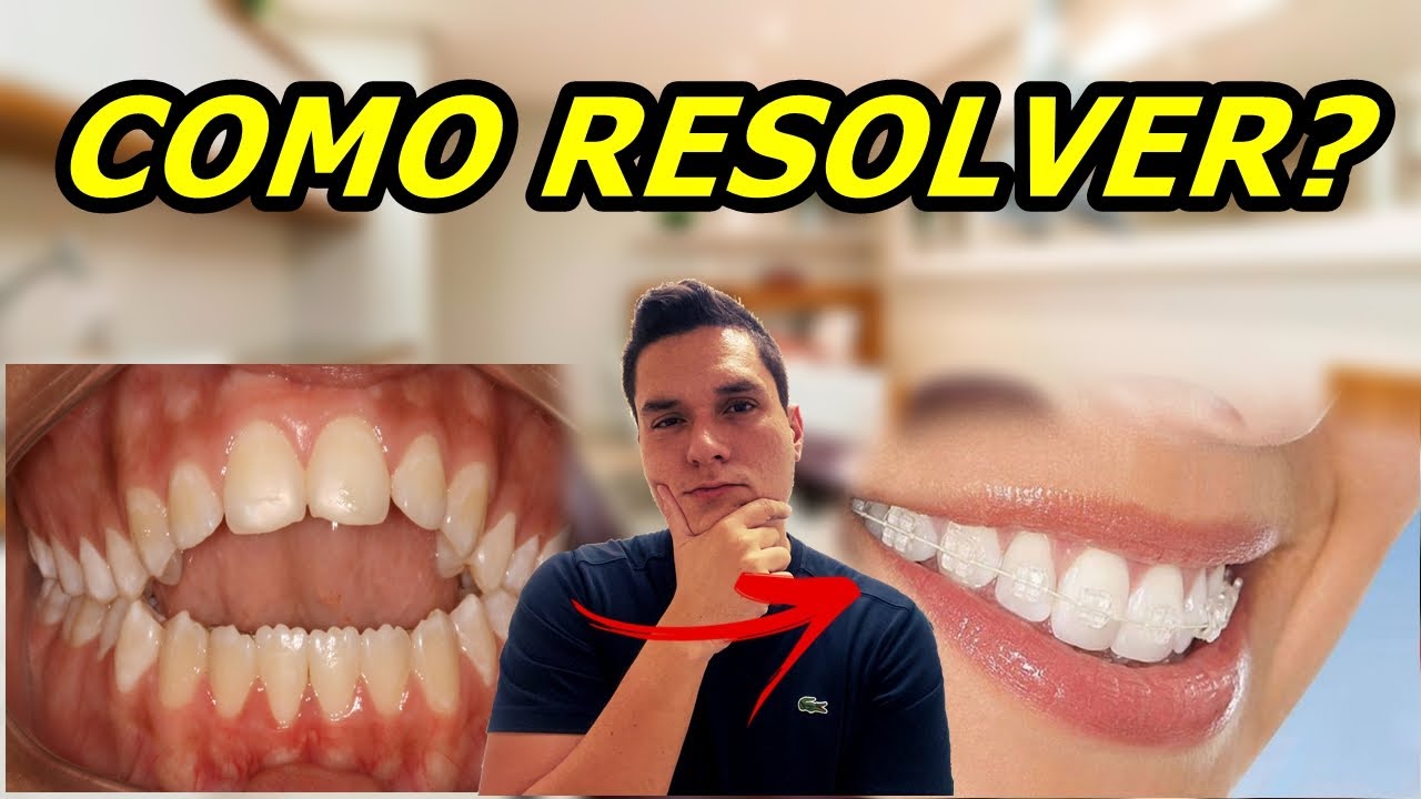 MORDIDA ABERTA | CAUSAS E TRATAMENTO!