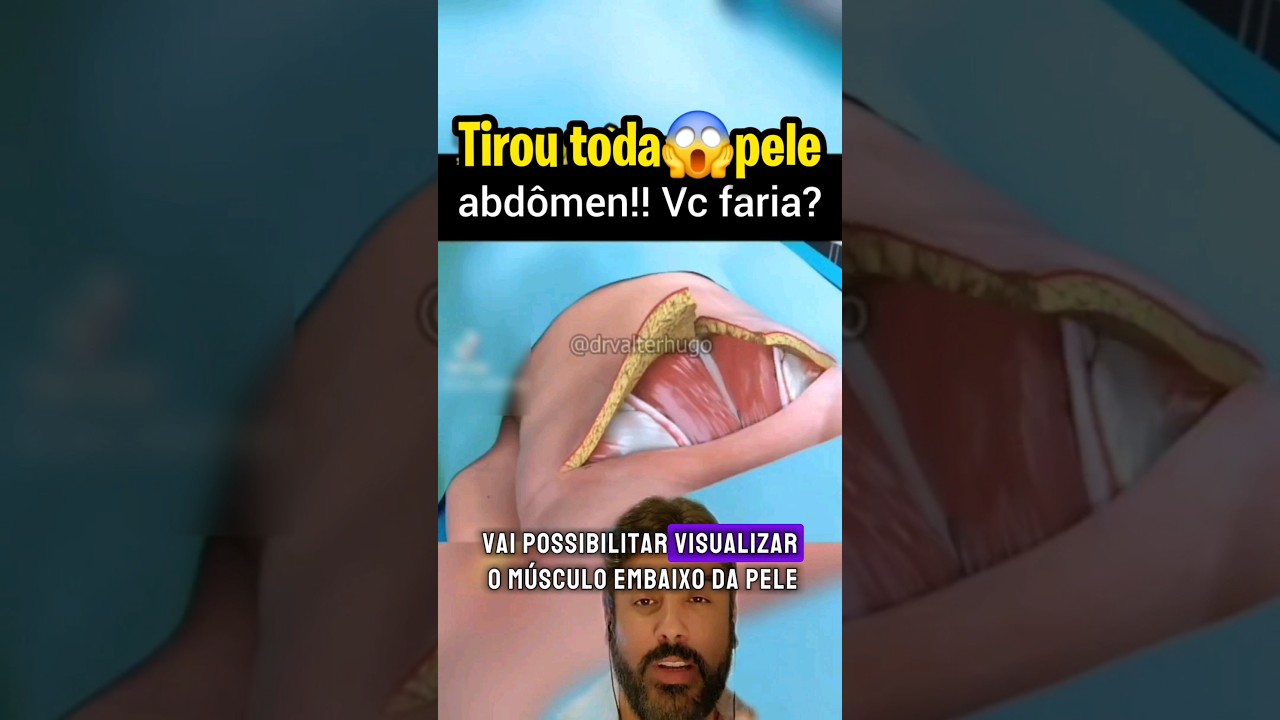 TIROU 2KG PELE NA ABDOMINOPLASTIA!!! Vc faria??? #abdominoplastiahd #lipohd #diastase