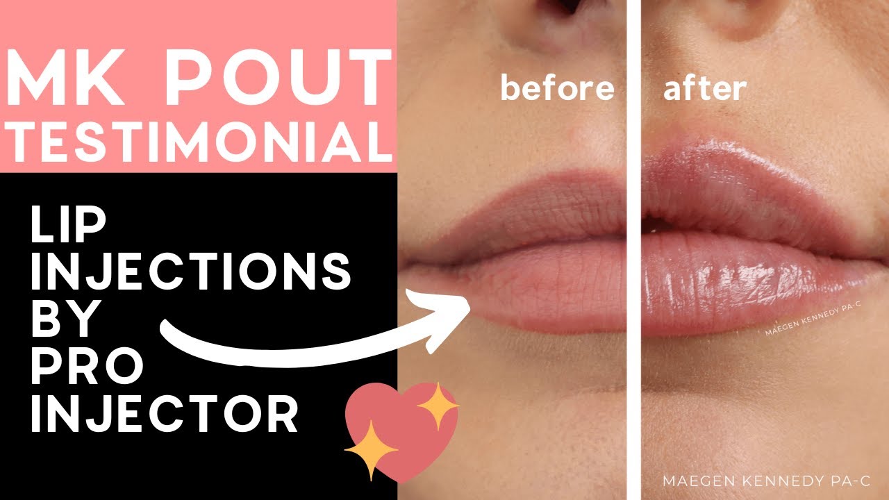 💉✨ LIP INJECTIONS TESTIMONIAL - The MK Pout - Orlando, FL - Restylane Kysse 💉✨