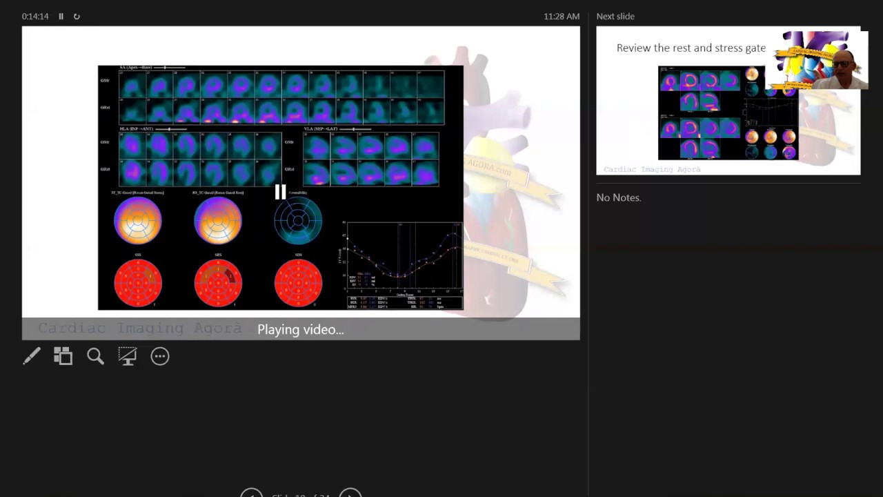 Step by Step Reading of a Cardiac SPECT: Optimizing the Value of AC