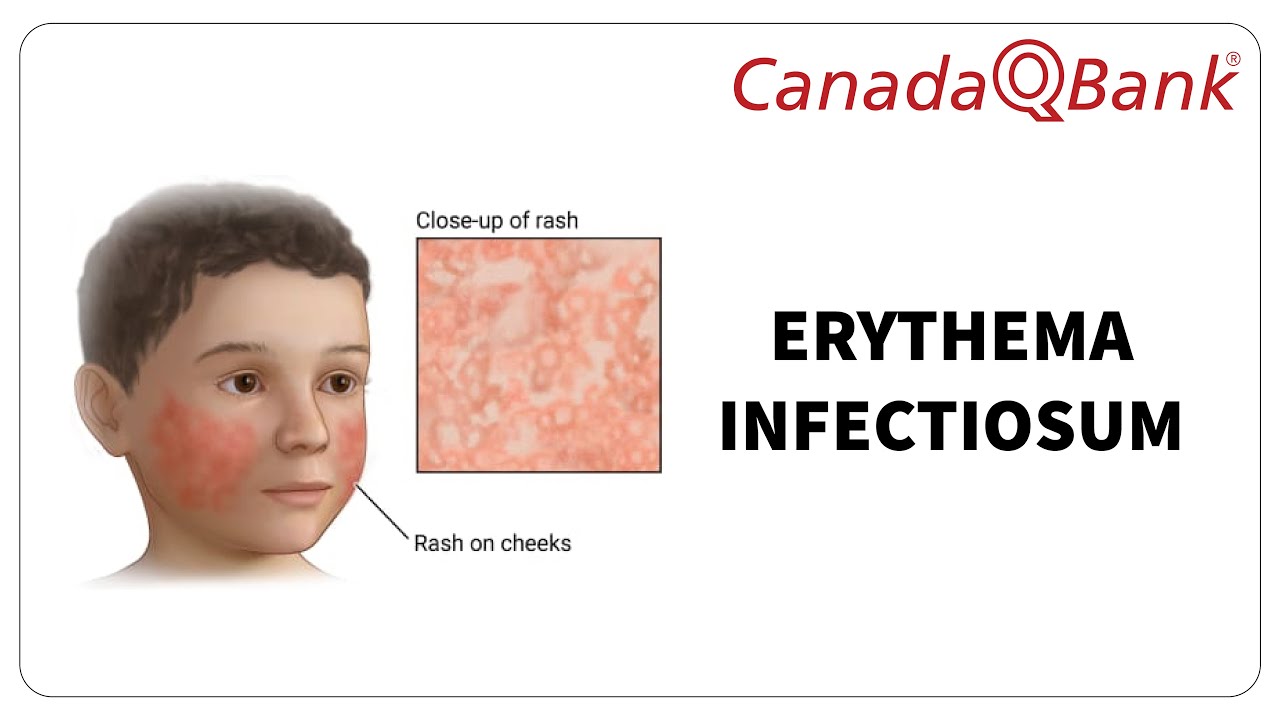 Erythema Infectiosum (Fifth Disease): Symptoms, Diagnosis & Treatment | CanadaQBank