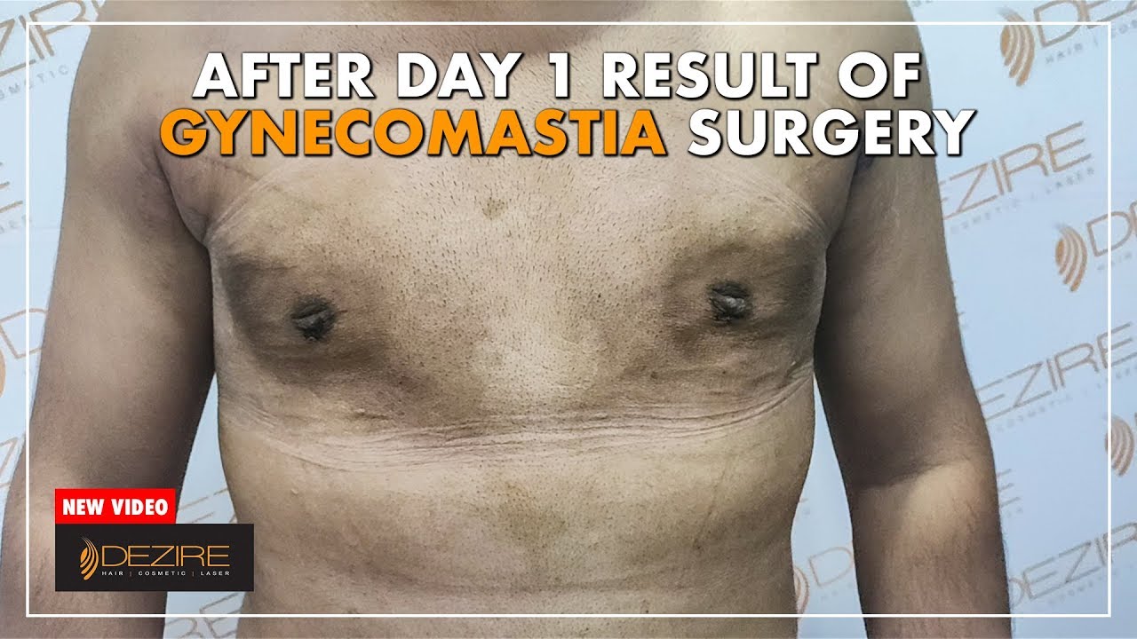 Gynecomastia Surgery Recovery Update | 1 Day Post Surgery Result | Dezire Clinic