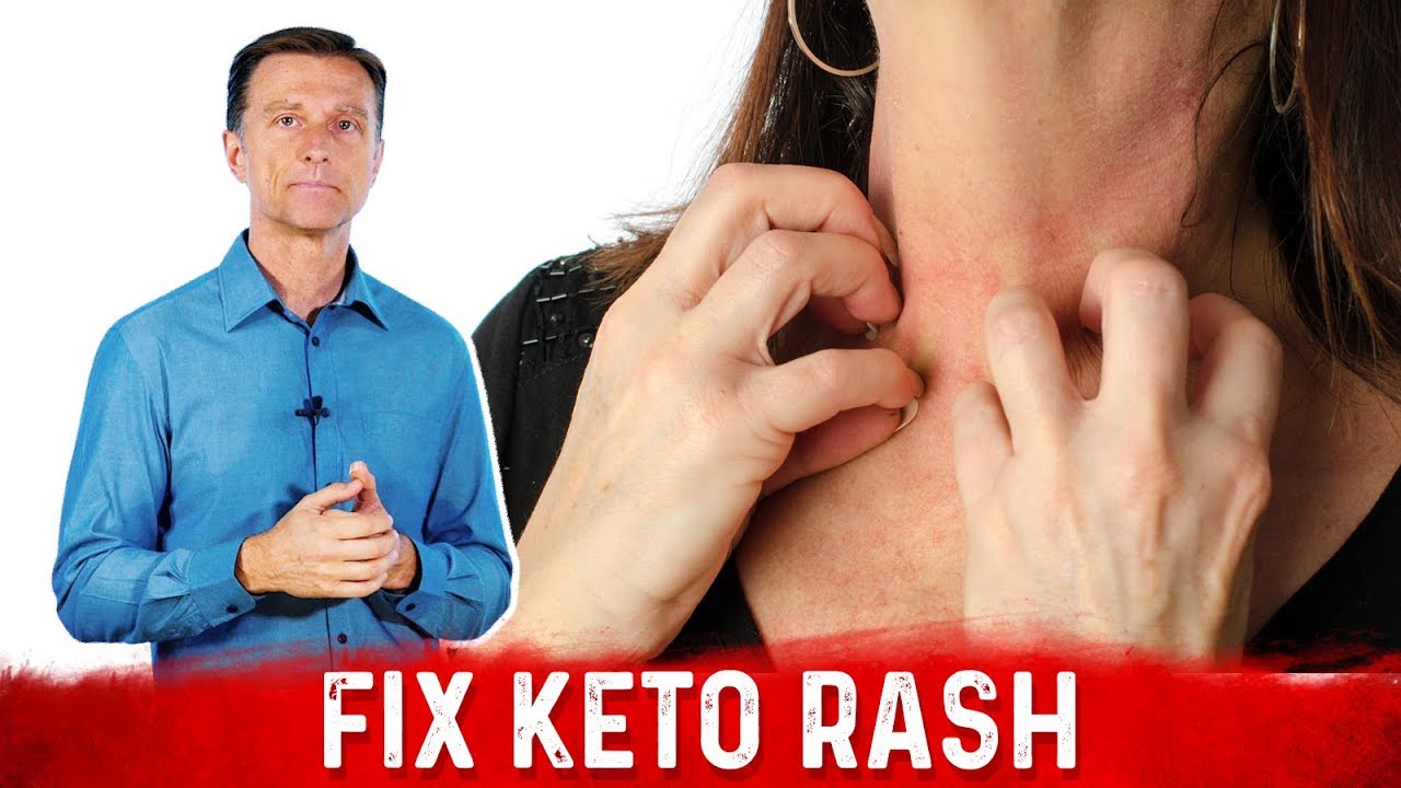 Keto Rash is a Vitamin B2 (Riboflavin) Deficiency &ndash; Dr.Berg