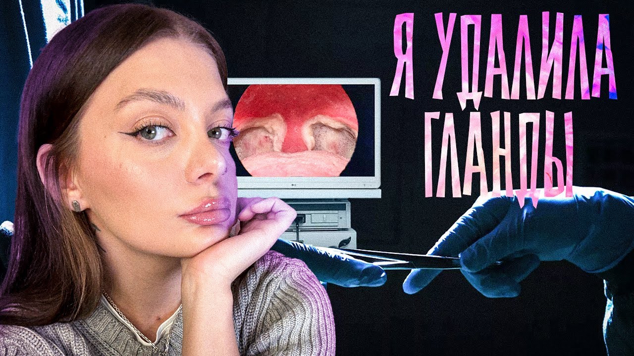 Я УДАЛИЛА ГЛАНДЫ!!! Тонзиллоэктомия - лучшее решение в моей жизни. Ангина/тонзиллит