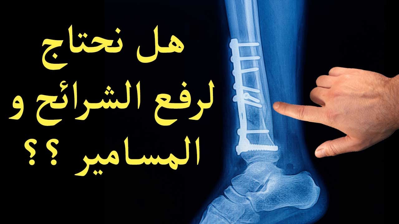 رفع الشرائح و المسامير - إزالة الشرايح والمسامير النخاعية