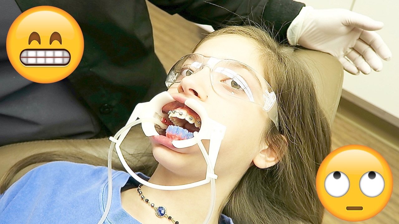 BRACES VLOG | ...HOW IT IS DONE!