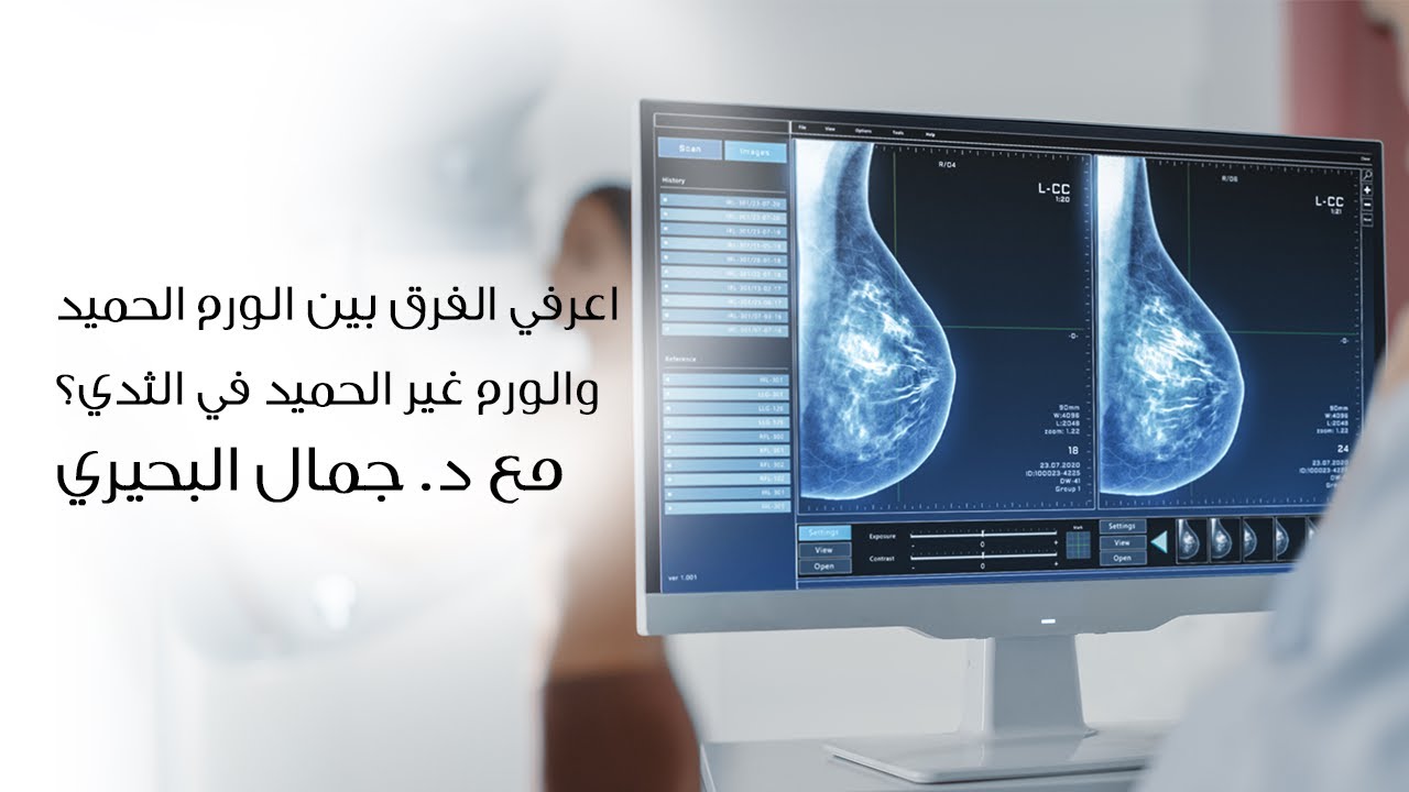 اعرفي الفرق بين الورم الحميد والورم غير الحميد في الثدي