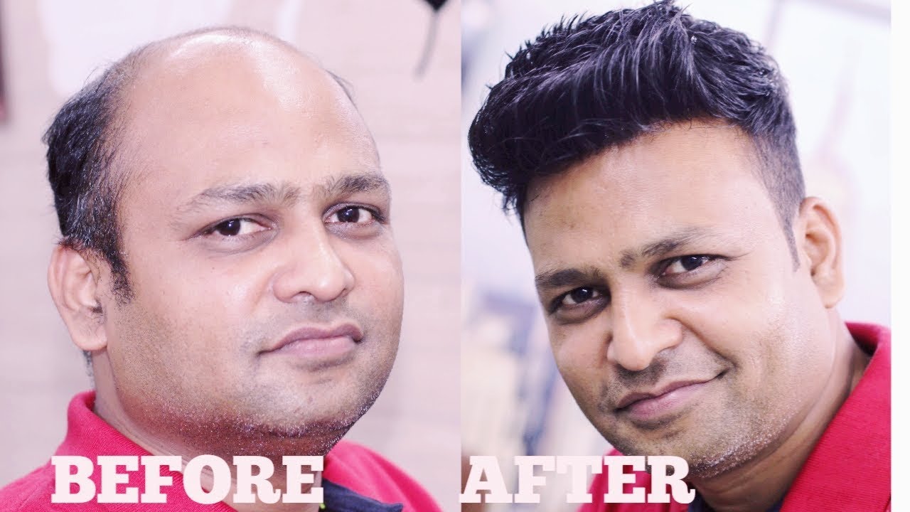 best hair patching system, parmanent wig solution in delhi 8882017181,8929576395