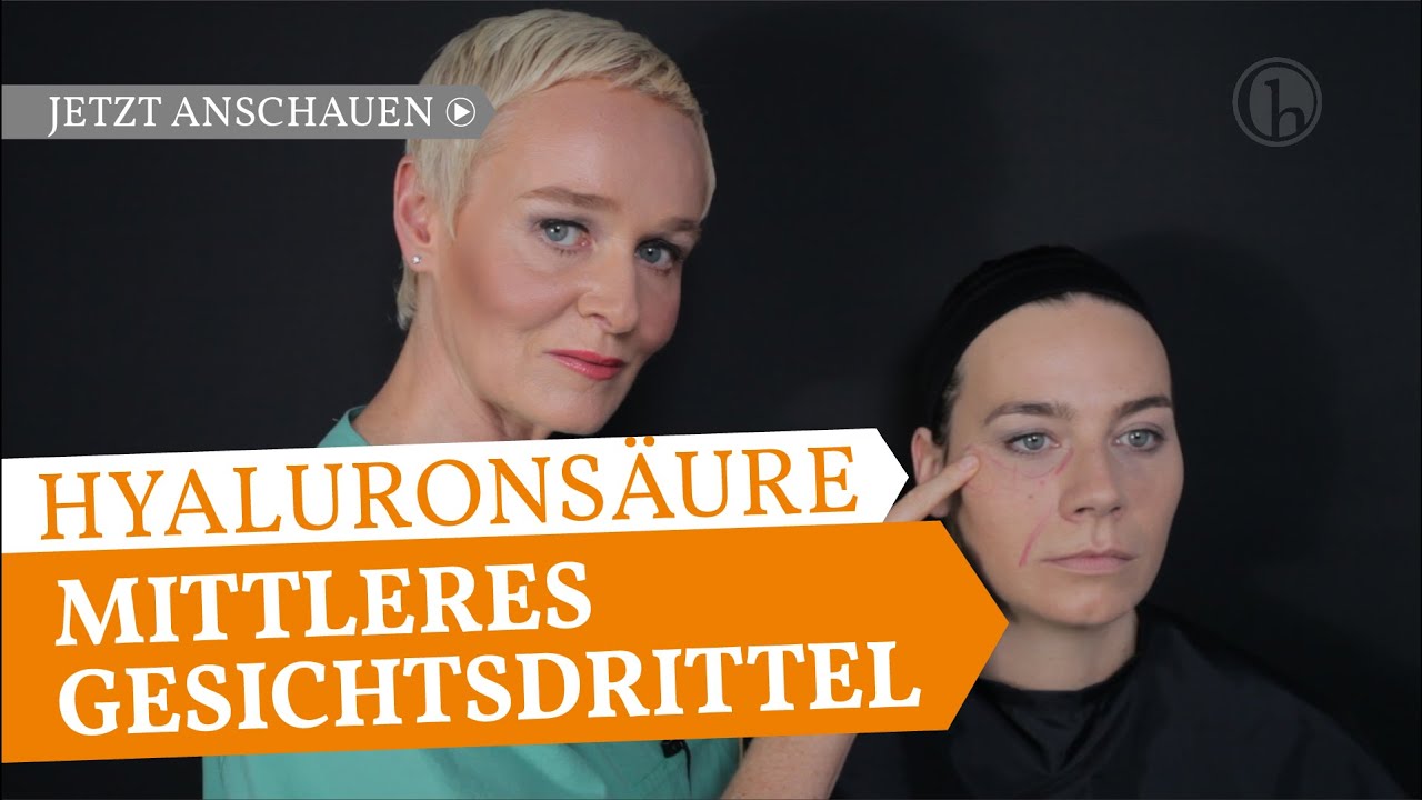 Faltenbehandlung mit Hyaluronsäure-Wangen, Nasolabialfalte, Tränenrinne- Dr. Simone Hellmann Köln