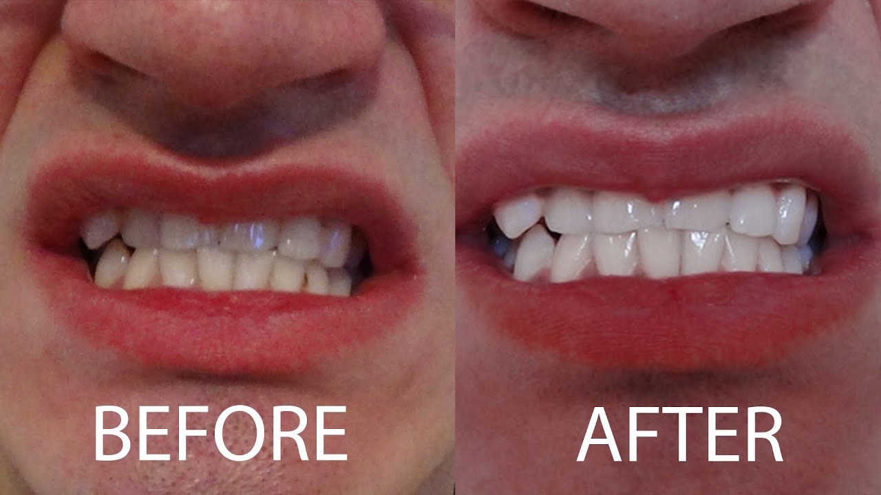 Teeth Whitening Tutorial & Giveaway: Binaural ASMR