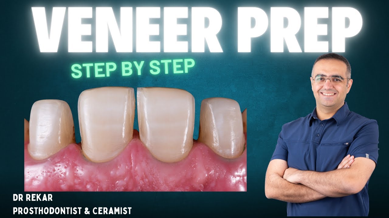 🔹 Step-by-Step Veneer Preparation & Cementation! 🔹 Part One