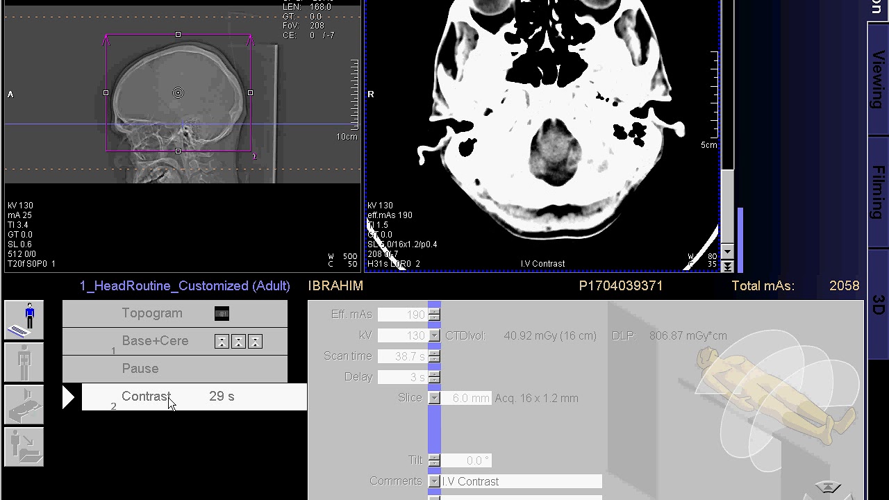 CT scan of  Brain with contrast full work '
