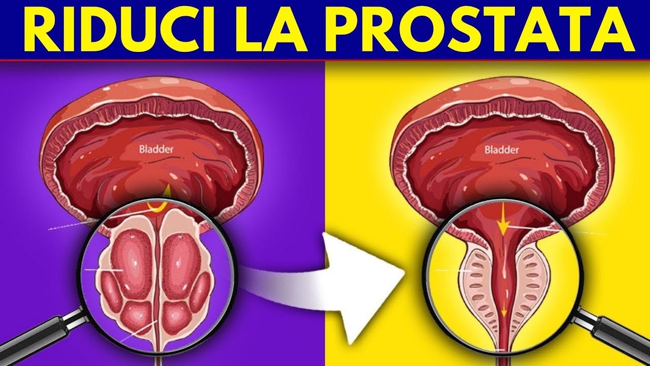 Come RIDURRE la PROSTATA in modo naturale: il NUTRIENTE n. 1 di cui hai bisogno