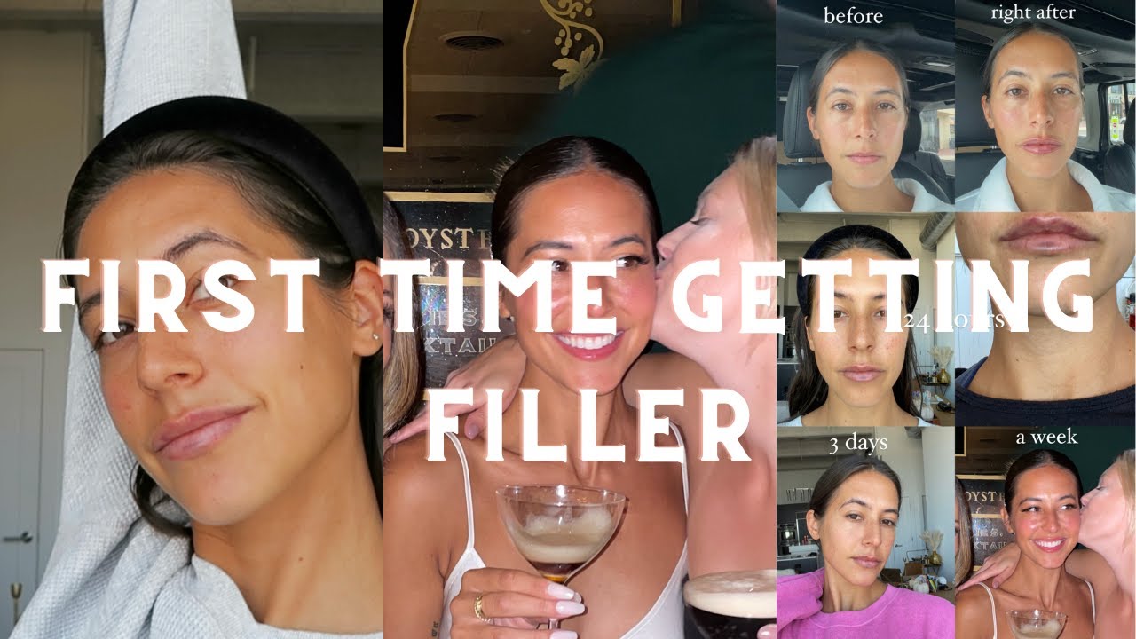 I GET FILLER FOR THE FIRST TIME