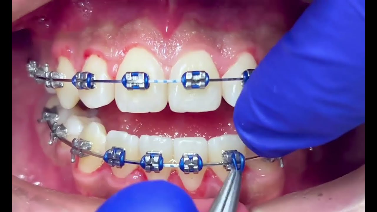 “¡El cambio es REAL! Así mejoró su sonrisa con brackets”