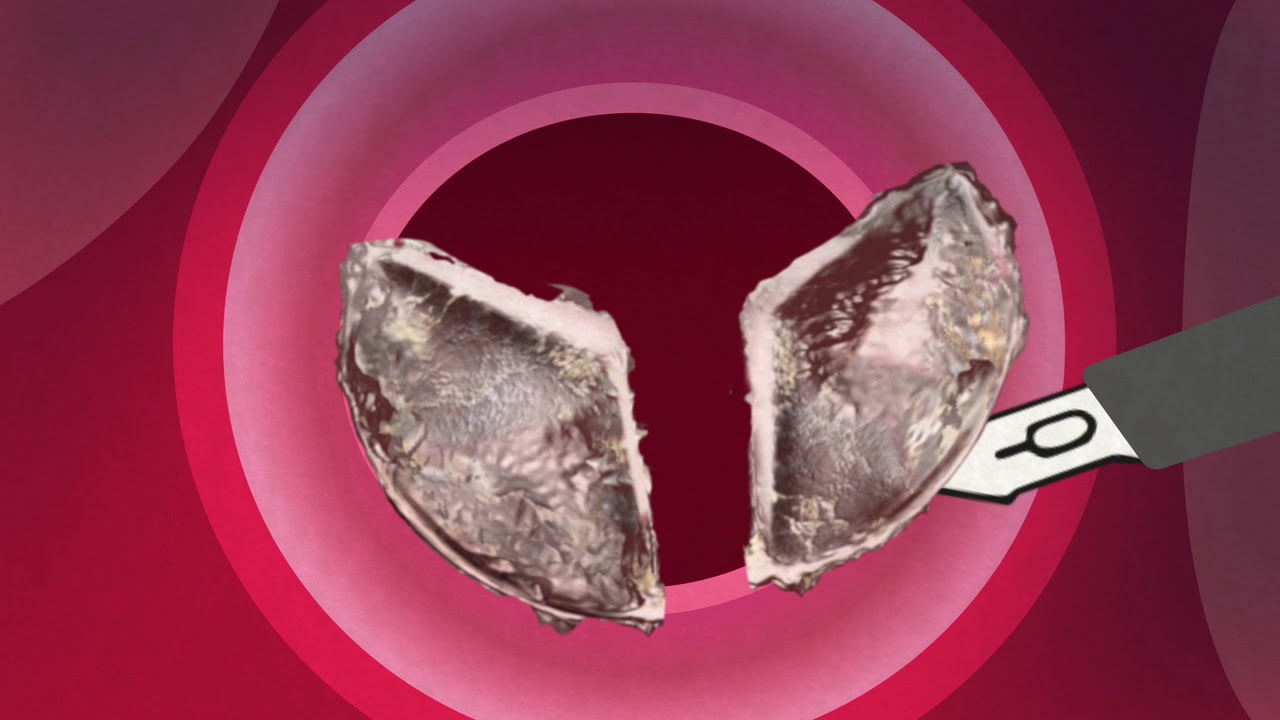 Chirurgische aortaklepvervanging (SAVR)