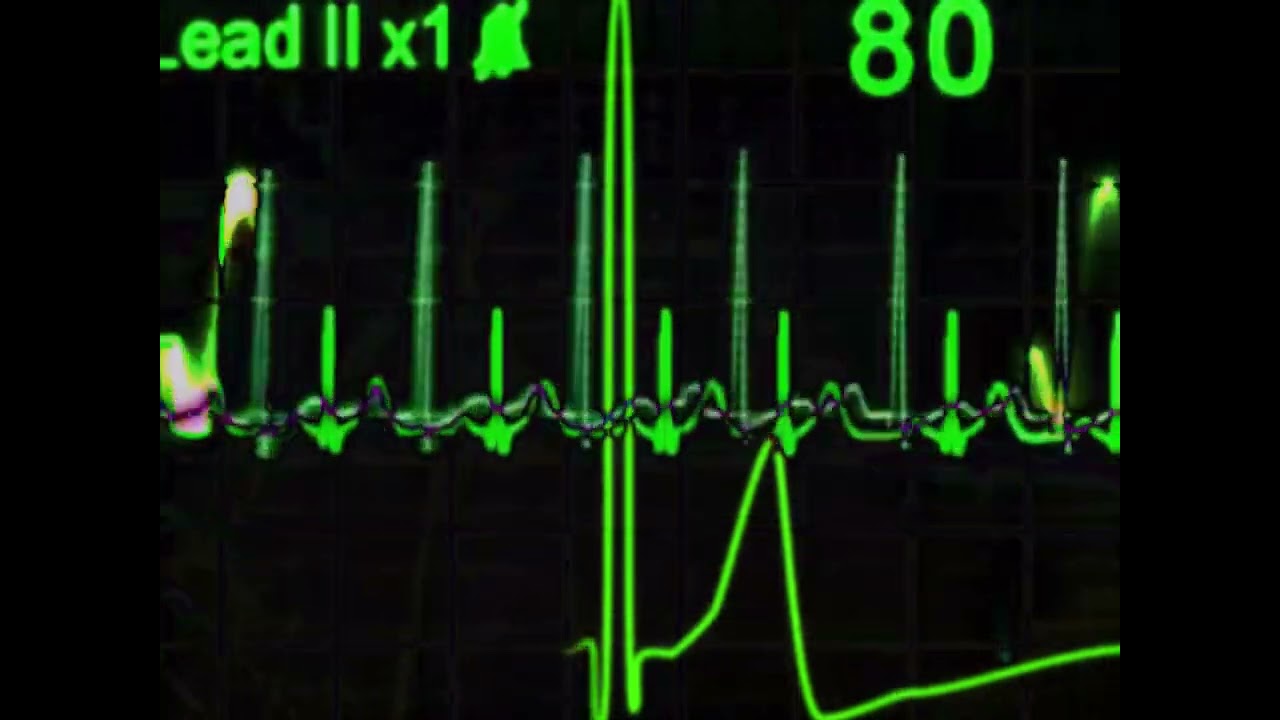 H33RA x CVIRO i GXNXVS - Kardiologiczny [wizualizator]